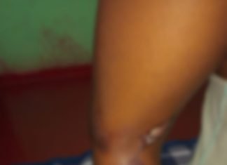 Polícia Civil procura por mãe suspeita de queimar filha de 8 anos com colher aquecida no fogo Polícia Civil procura por mãe suspeita de queimar filha de 8 anos com colher aquecida no fogo