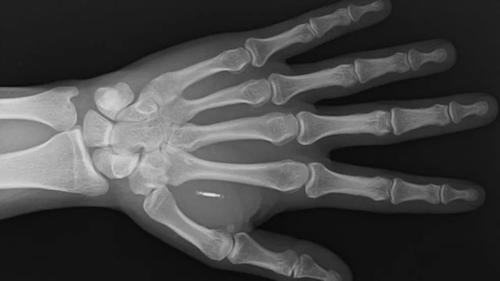 Os microchips que permitem pagamento com a mão Os microchips que permitem pagamento com a mão